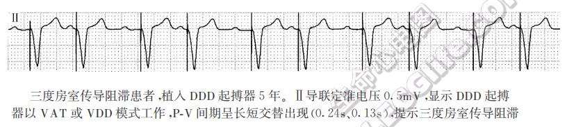 起搏融合波与伪融合波