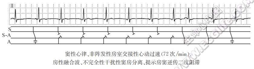 窦性心律、非阵发性房室交接性心动过速(72次/min)、房性融合波、不完全性干扰性窦房分离、提示房窦逆传二度阻滞（心电图）