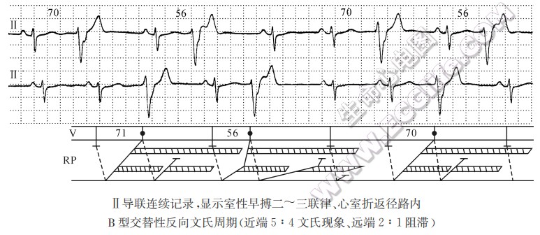 折返径路内双层阻滞与多层阻滞