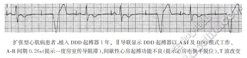 扩张型心肌病患者，植入DDD起搏器1年。Ⅱ导联显示DDD起搏器以AAI及DDD模式工作、AR间期0.26s（提示一度房室传导阻滞）、间歇性心房起搏功能不良（提示心房电极半脱位）、T波改变