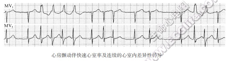 心房颤动伴快速心室率及连续的心室内差异性传导（心电图）
