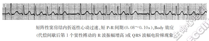 短阵性窦房结内折返性心动过速、短P-R间期(0.08～0.10s)、Body效应（代偿间歇后第1个窦性搏动的R波振幅增高）或QRS波幅电阶梯现象（心电图）