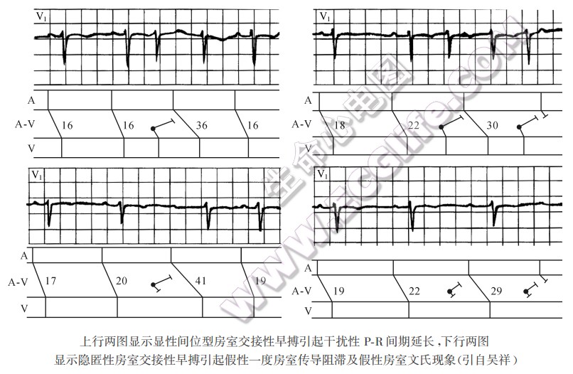 上行两图显示显性间位型房室交接性早搏引起干扰性PR间期延长，下行两图显示隐匿性房室交接性早搏引起假性一度房室传导阻滞及假性房室文氏现象（引自吴祥）