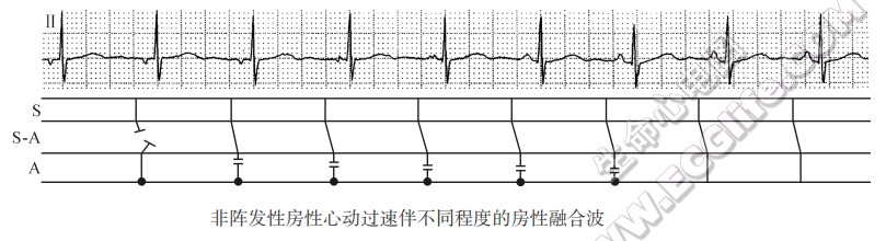 非阵发性房性心动过速伴不同程度的房性融合渡（心电图）