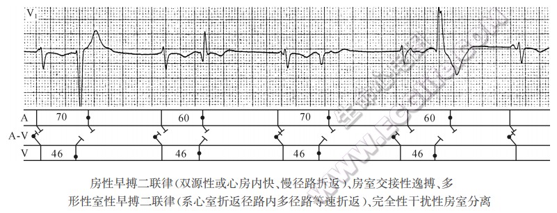 房性早搏二联律（双源性或心房内快、慢径路折返）、房室交接性逸搏、多形性室性早搏二联律（系心室折返径路内多径路等速折返）、完全性干扰性房室分离