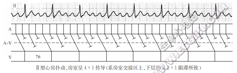 Ⅱ型心房扑动、房室呈4:1传导（系房室交接区上、下层均呈2:1阻滞所致）