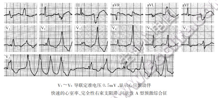 V1～V6导联定准电压0.5mV湿示心房颤动伴快速的心室率、完全性右束支阻滞、间歇性A型预激综合征（心电图）
