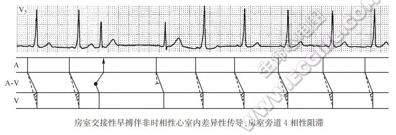 房室交接性早搏伴非时相性心室内差异性传导、房室旁道4相性阻滞（心电图）