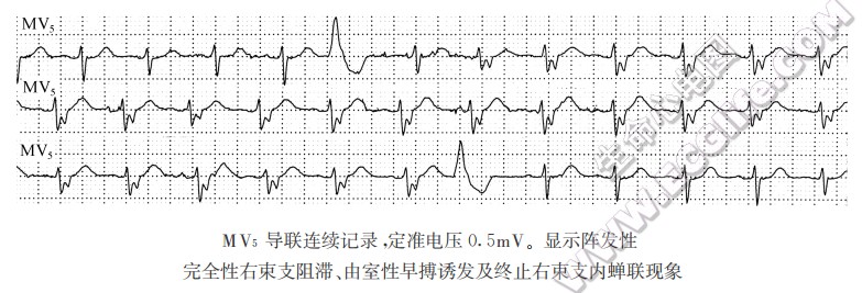 MV5导联连续记录，定准电压0.5mV。显示阵发性完全性右柬支阻滞、由室性早搏污发及终止右柬支内蝉联现象（心电图）