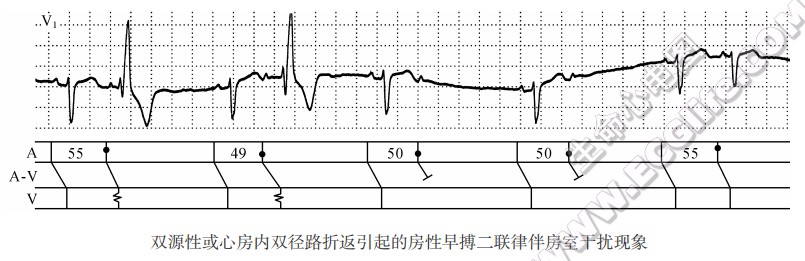 双源性或心房内双径路折返引起的房性早搏二联律伴房室干扰现象（心电图）