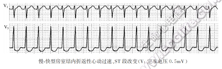 慢．快型房室结内折返性心动过速、ST段改变（心电图）