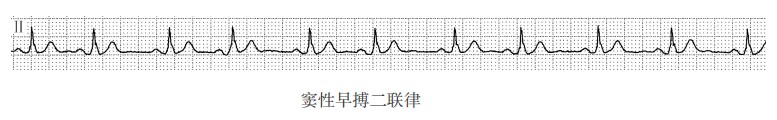 窦性早搏二联律