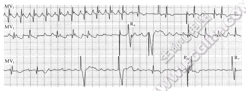 关注心房扑动、颤动时DDD起搏心电图