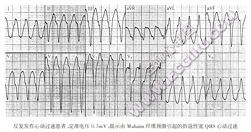 反复发作心动过速患者，定准电压0.5mV，提示由Mahaim纤维预激引起的折返性宽QRS心动过速