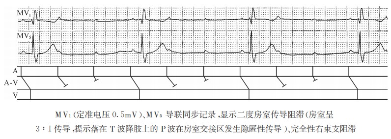 MV1(定准电压0.5mV)、MV5导联同步记录湿示二度房室传导阻滞（房室呈3：1传导，提示落在T波降肢上的P波在房室交接区发生隐匿性传导）、完全性右柬支阻滞