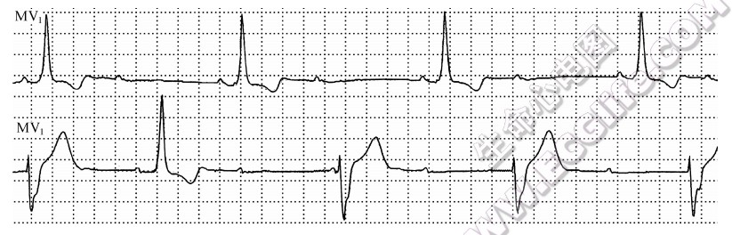 房室分离心电图特征