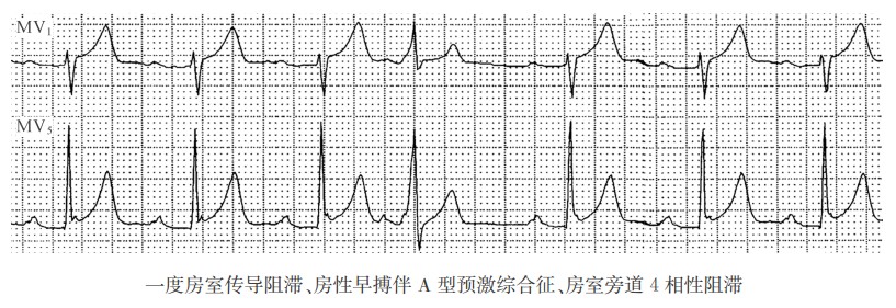 一度房室传导阻滞、房性早搏伴A型预激综合征、房室旁道4相性阻滞（心电图）