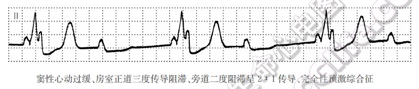 窦性心动过缓、房室正道三度传导阻滞、旁道二度阻滞呈2:1传导、完全性预激综合征（心电图）