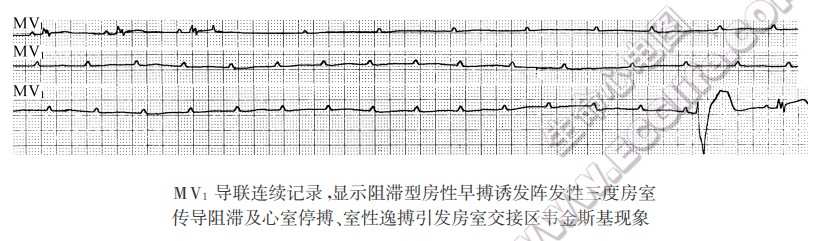 MV1导联连续记录，显示阻滞型房性早搏诱发阵发性三度房室传导阻滞及心室停搏、室性逸搏引发房室交接区韦金斯基现象（心电图）