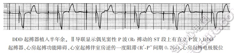 DDD起搏器植入半年余。Ⅱ导联显示偶见窦性P波、DDD起搏器、心房起搏功能障碍、心室起搏伴室房逆传一度阻滞、心房起搏电极脱位