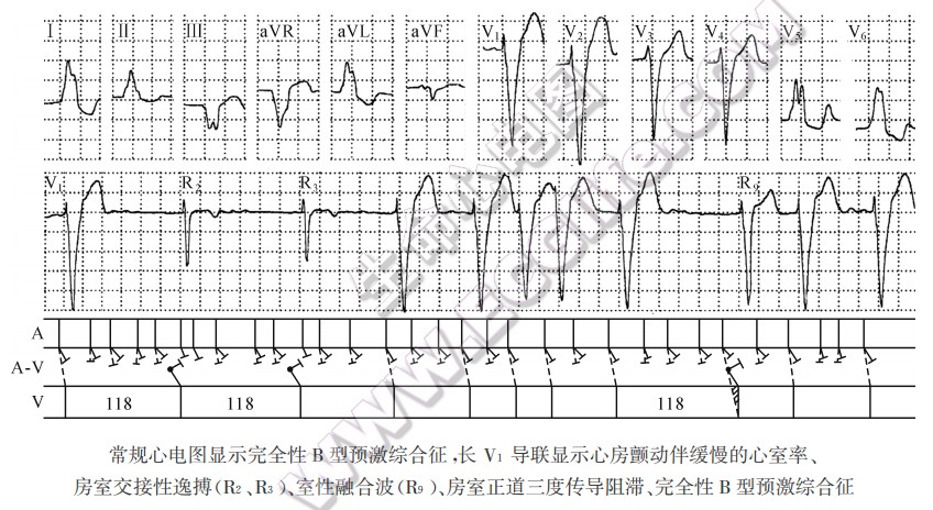 常规心电图显示完全性B型预激综合征，长Vi导联显示心房颤动伴缓慢的心室率、房室交接性逸搏、室性融合波、房室正道三度传导阻滞、完全性B型预激综合征（心电图）