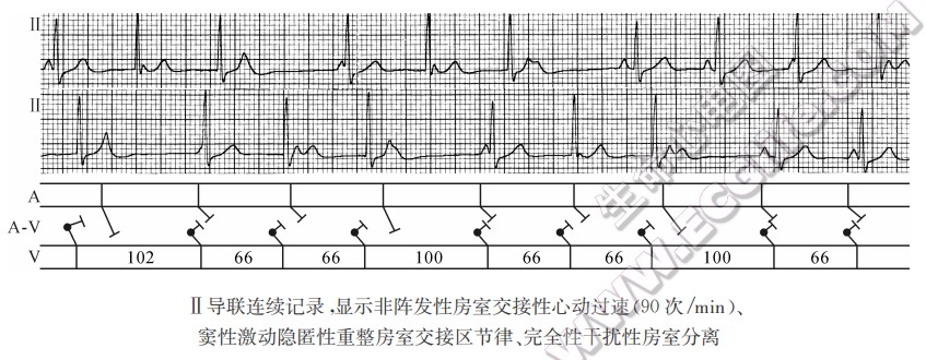 Ⅱ导联连续记录湿示非阵发性房窒交接性心动过速(90次/mjn)、窦性激动隐匿性重整房室交接区节律、完全性干扰性房室分离