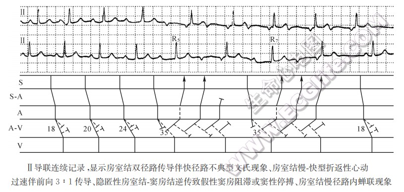 Ⅱ导联连续记录，显示房室结双径路传导伴快径路不典型文氏现象、房室结慢一决型折返性心动过速伴前向3：1传导、隐匿性房室结-窦房结逆传致假性窦房阻滞或窦性停搏、房室结慢径路内蝉联现象