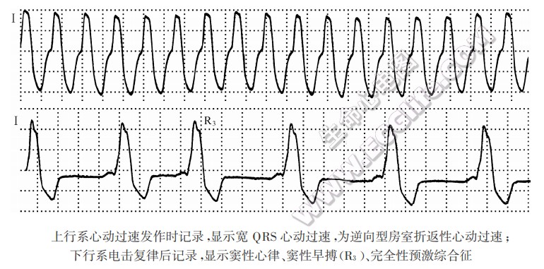 上行系心动过速发作时记录，显示宽QRS心动过速，为逆向型房室折返性心动过速；下行系电击复律后记录，显示窦性心律、窦性早搏(R3)、完全性预激综合征（心电图）