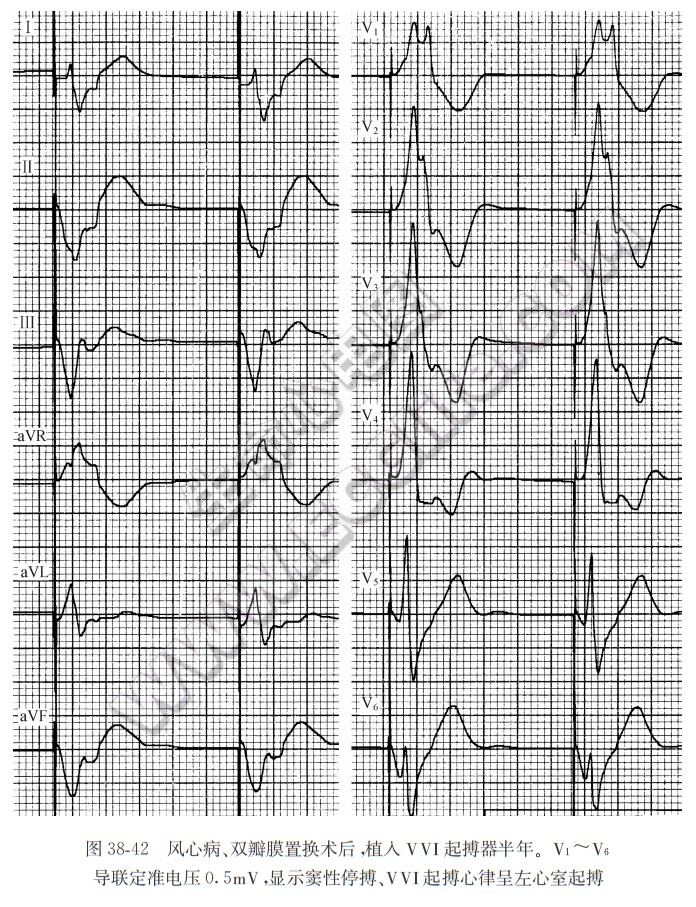 风心病、双瓣膜置换术后，植入VVI起搏器半年。V1～V6导联定准电压0.5mV，显示窦性停搏、VVI起搏心律呈左心室起搏