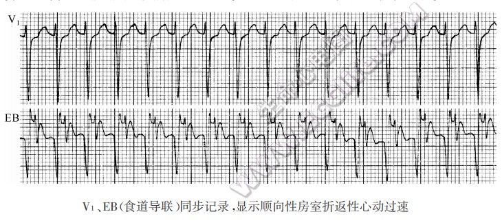 V1、EB（食道导联）同步记录，显示顺向性房室折返性心动过速