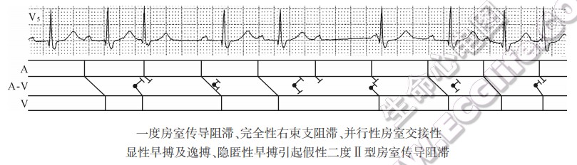 一度房室传导阻滞、完全性右柬支阻滞、并行性房室交接性显性早搏及逸搏、隐匿性早搏引起假性二度Ⅱ型房室传导阻滞（心电图）