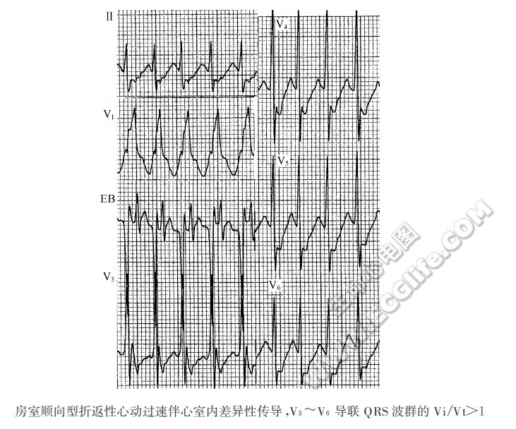 房室顺向型折返性心动过速伴心室内差异性传导
