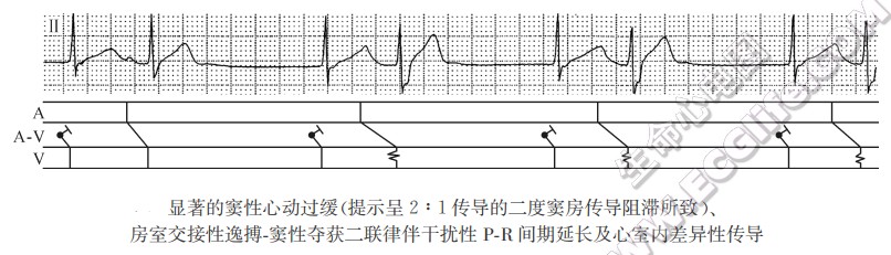 显著的窦性心动过缓房室交接性逸搏一窦性夺获二联律伴干扰性P-R间期延长及心室内差异性传导（心电图）