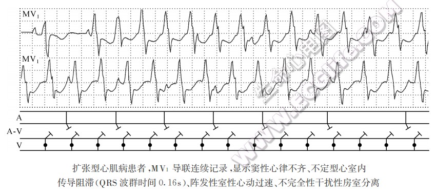宽QRS心动过速的类型及心电图特征