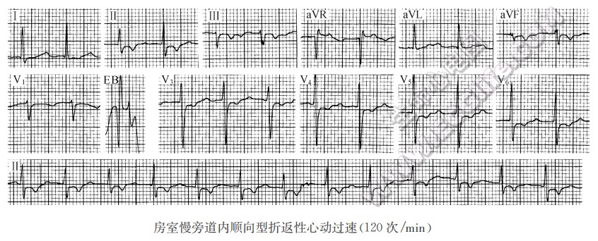 房室慢旁道内顺向型折返性心动过速(120次/min)（心电图）