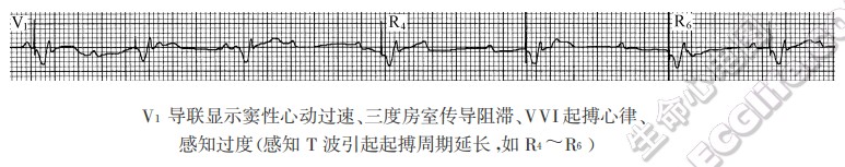 V1导联显示窦性心动过速、三度房室传导阻滞、VVI起搏心律、感知过度（感知T波引起起搏周期延长，如R4~R6）