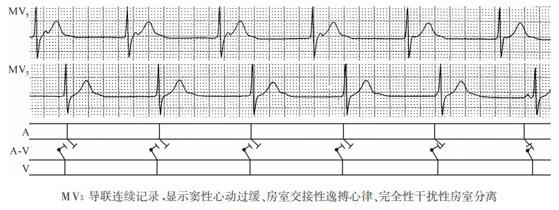 MV5导联连续记录，显示窦性心动过缓、房室交接性逸搏心律、完全性干扰性房室分离（心电图）