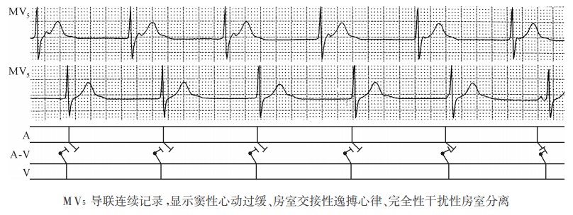 干扰性房室分离