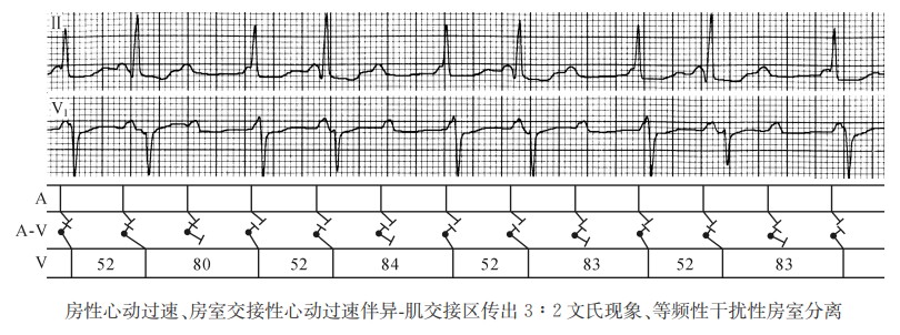 房性心动过速、房室交接性心动过速伴异一肌交接区传出3:2文氏现象、等频性干扰性房室分离