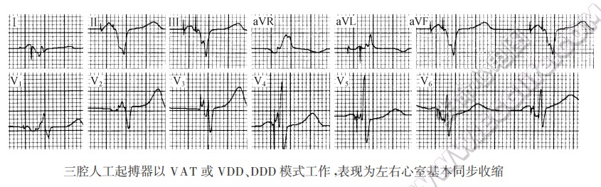 三腔人工起搏器以VAT或VDD、DDD模式工作，表现为左右心室基本同步收缩（心电图）
