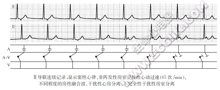 心房分离：阻滞性、干扰性心房分离