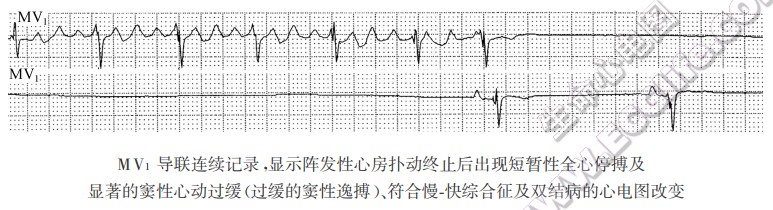 病窦综合征（病态窦房结综合征）及双结病