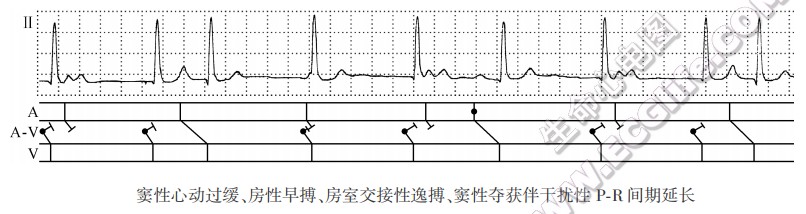 窦性心动过缓、房性早搏、房室交接性逸搏、窦性夺获伴干扰性PR间期延长（心电图）