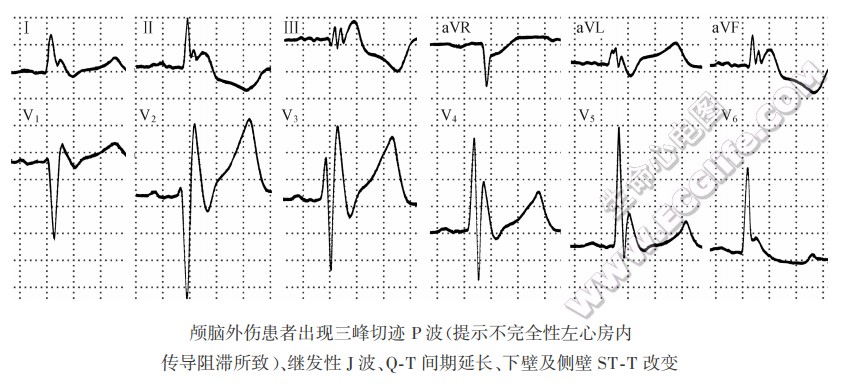 颅脑外伤患者出现三蜂切迹P波（提示不完全性左心房内传导阻滞所致）、继发性J波、Q-T间期延长、下壁及侧壁ST-T改变（心电图）