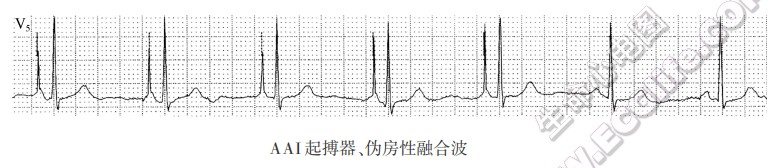 心房起搏（AAI心脏起搏器）的心电图特征