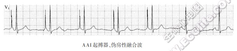 AAI心脏起搏器、伪房性融合波