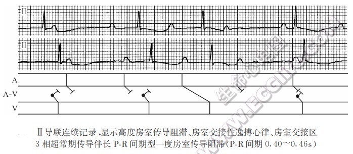 Ⅱ导联连续记录，显示高度房室传导阻滞、房室交接性逸搏心律、房室交接区3相超常期传导伴长PR间期型一度房室传导阻滞(PR间期0.40-0.46s)（心电图）