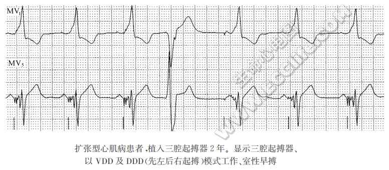 扩张型心肌病患者，植入三腔起搏器2年。显示三腔起搏器、以VDD及DDD(先左后右起搏)模式工作、室性早搏