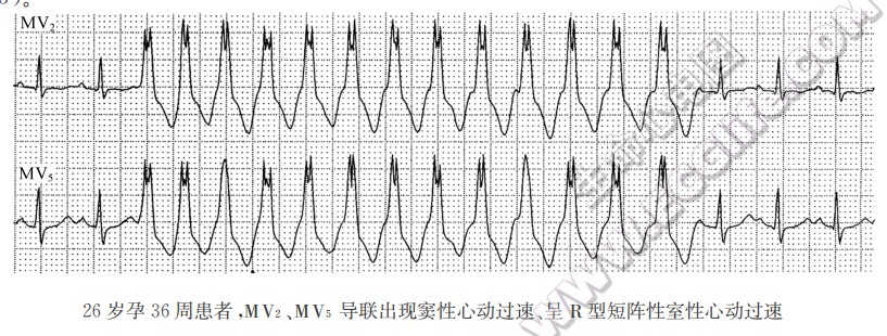 宽大畸形的qrs波心电图图片