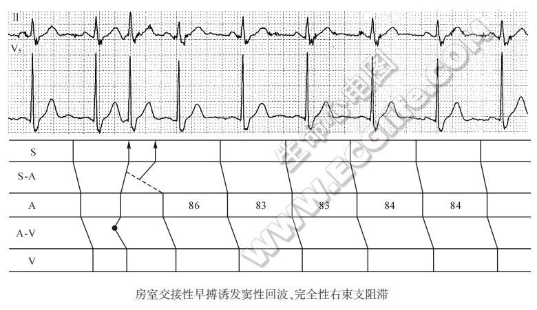 窦房交接区双径路传导